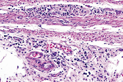 Proventriculite ou PPD